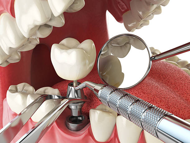 Tooth Infection Emergency Dentist in SC